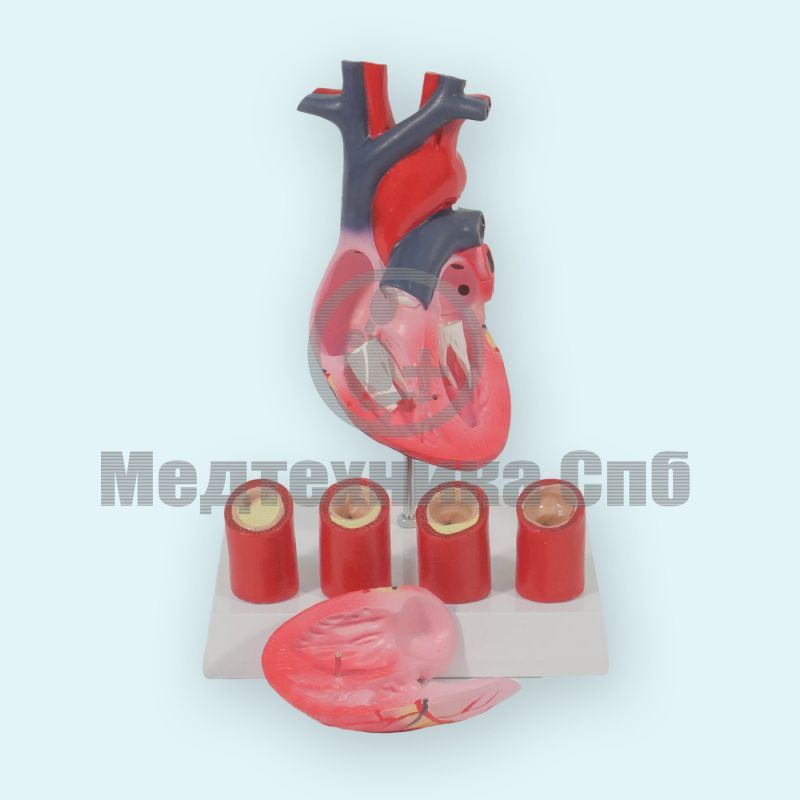 Модель сердца с патологией артерий