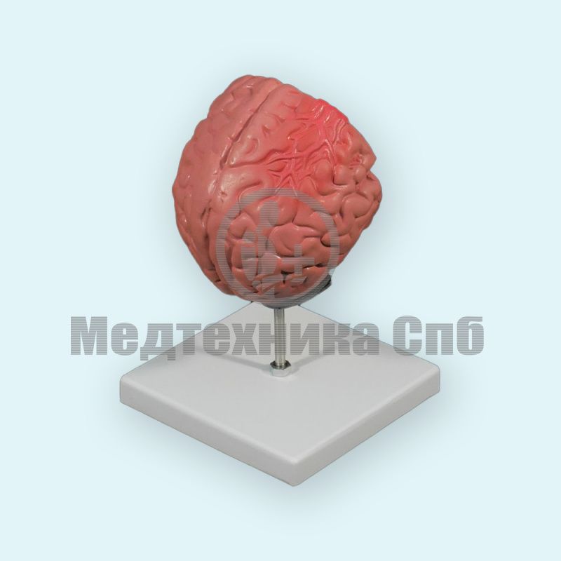 Модель патологий головного мозга (на подставке)