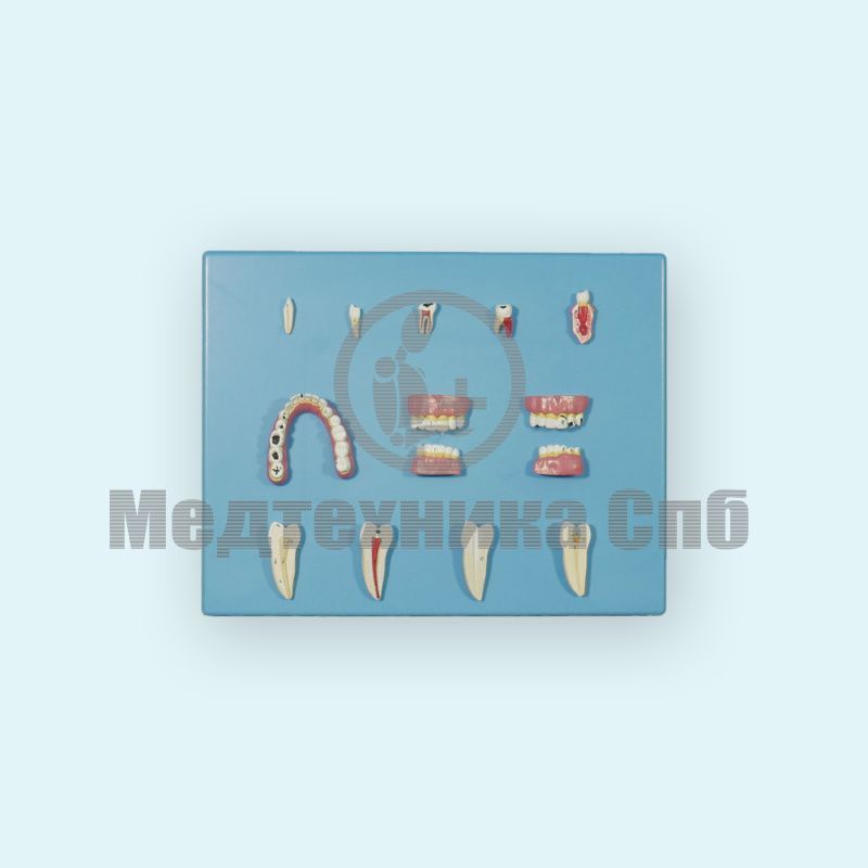 Модель болезней зубов, 12 частей